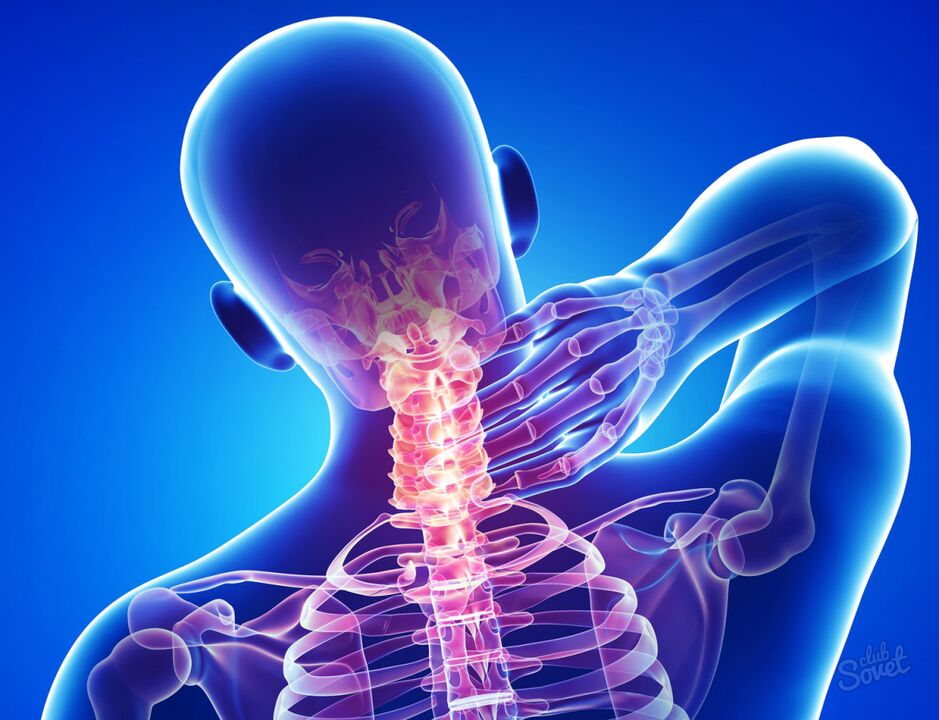 osteocondrosi cervicale