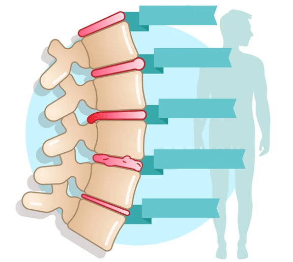 Grado di malattia dell'osteocondrosi toracica