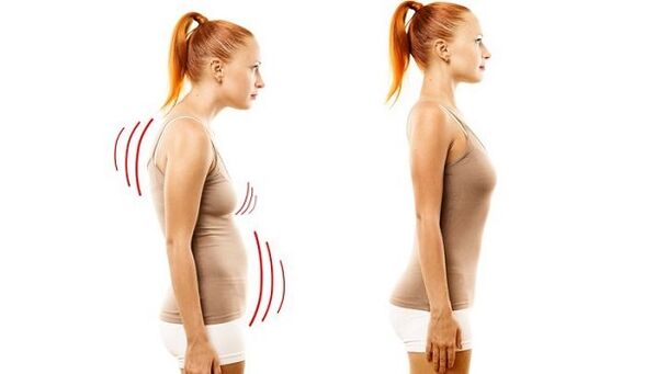 schiena dritta e postura scorretta con osteocondrosi cervicale