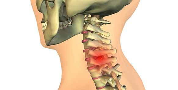 cambiamenti nella colonna vertebrale con osteocondrosi cervicale